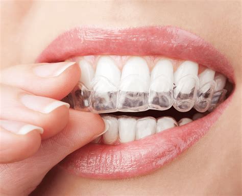 Compare Removable Braces With Fixed Braces Pros And Cons