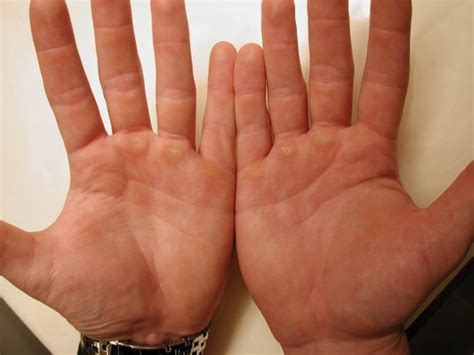What Causes Lump To Appear In Your Palm Med