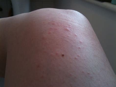 Itchy bumps on legs may occur due to a variety of causes. Circular Bumps On My Arms Legs And Back - Soft Porno Movie