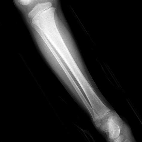 Stress Fracture Tibia X Ray