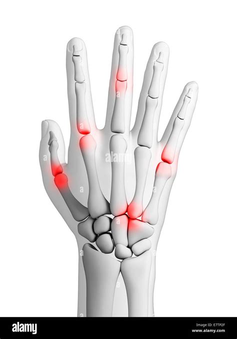 Las Articulaciones De La Mano Humana Mostrando La Artritis Equipo De