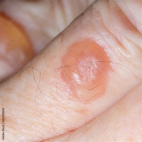 Blisters Caused By Cryotherapy Fro Solar Keratosis On Skin Of 64 Year
