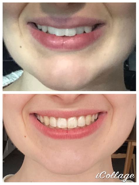 Finally Done 🎉🎉 Info In Comments R Invisalign