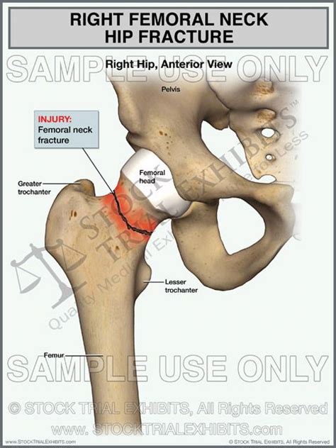 Hip Fracture Hip Fracture Rheumatoid Arthritis Treatment Anatomy