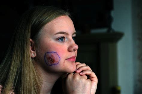 Teenager Wakes Up With Two Sinister Puncture Wounds On Her Cheek Real Fix