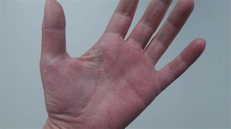 What Causes Itchy Bumps On Palms Of Hands