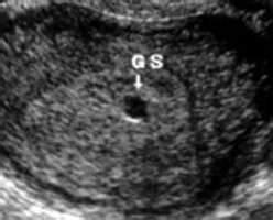 This is about the time that a scan can pick up your baby's heart beat for the first time. What would an ultrasound show at 4 weeks of pregnancy? - Quora