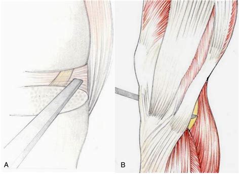 The Risk Of Direct Peroneal Nerve Injury Using The Ranawat “inside Out