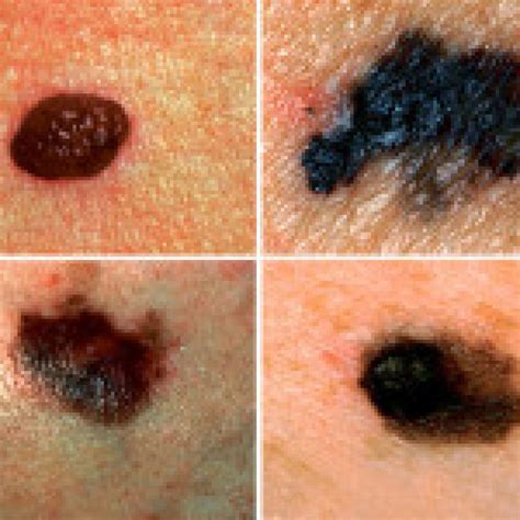Are Moles Skin Cancer Or Melanoma What Is A Mole Mtm