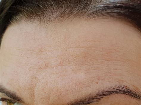 Your Forehead Wrinkles Might Actually Be Dehydration Lines — Heres How