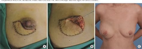 Figure 1 From Immediate Breast Reconstruction Following Nipple Sparing