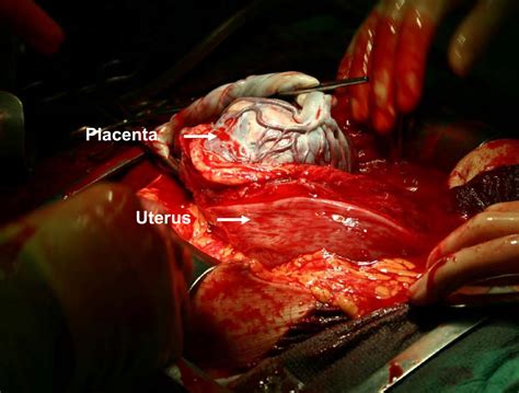 Placenta previa is a condition wherein the placenta of a pregnant woman is implanted abnormally in the uterus. Placenta previa percreta left in situ - management by ...
