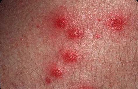 Pseudomonas Dermatitis Hot Tub Rash