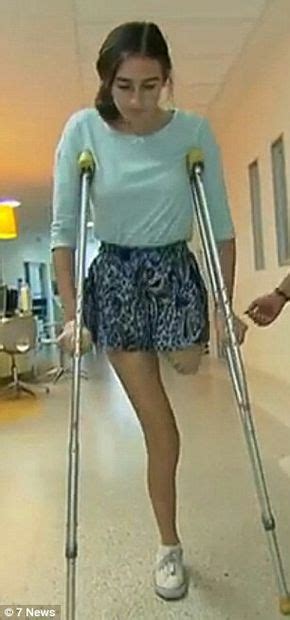 New Young Lak Amputee Taking Her First Steps On Crutches After A