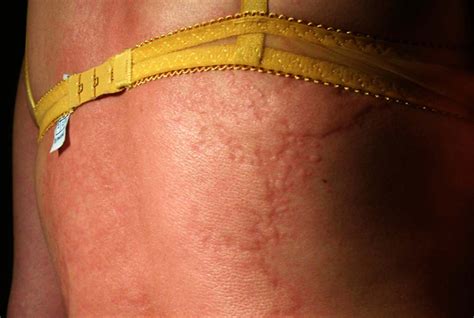 Nesselsucht Als Unbekannte Hautkrankheit Dermatologie Derstandard