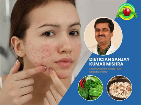 Nutrition For Acne Check Out This Diet To Reduce Acne On Your Skin