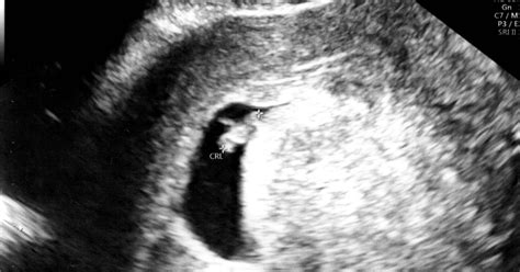 6 Week Ultrasound Scan Everything You Need To Know Pregnant