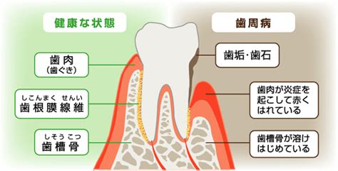 歯周病の治療 |  桜川市で痛みに耐えたインプラント・歯医者なら山王歯科