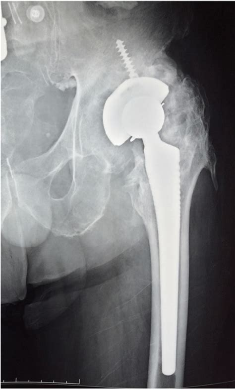 Preoperative Anteroposterior Radiograph Of The Left Hip Shows The