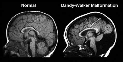 Dandy Walker Malformation Medizzy