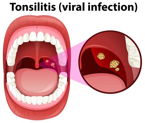 A Human Mouth Tonsillitis Infection 293529 Vector Art At Vecteezy