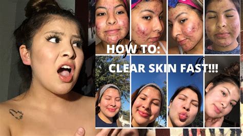 How To Clear Skin Fast Without Accutane Youtube