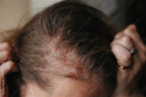 Psoriasis Vulgaris Psoriatic Skin Disease In Hair Skin Patches Are