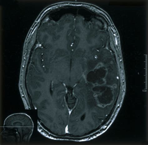 Mri Scan Brain Cancer Glioma Wellcome Collection