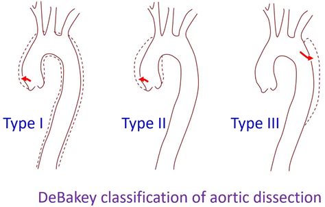 Aortic Dissection Mechanisms And Classification All About