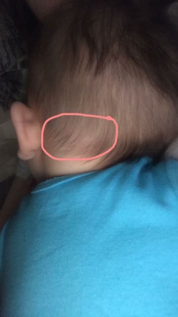 Baby Only Has One Palpable Pea Sized Lymph Node On His Head Glow