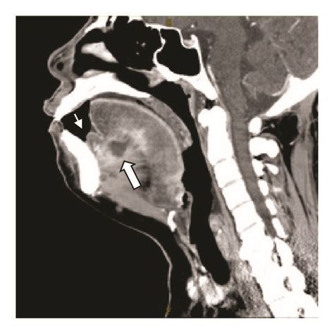 Contrast Enhanced Ct Scan Showed The Abscess Confined At The Ventral