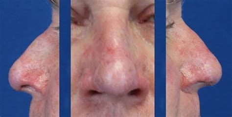 Facial Skin Cancer Reconstruction Musc Health Charleston Sc
