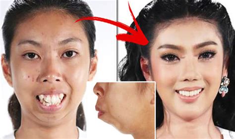 Plastic Surgery Transformation For Thai Woman Who Needs Chin Implant