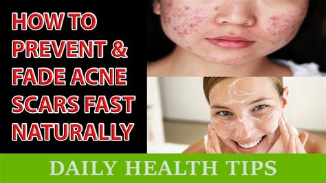 How To Prevent Acne Scars Naturally How To Prevent And Fade Acne