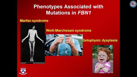 Evolution Of The Diagnosis Cause And Pathogenesis Of Marfan Syndrome Youtube