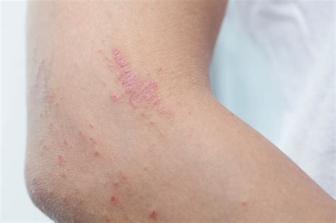 Most Common Skin Lesions Valley County Health System