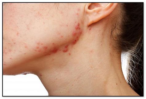 4 Simple Methods To Clear Up Acne Scars Acne Fix Society