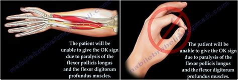 정중신경 포착median Nerve Entrapment 네이버 블로그