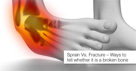The Difference Between A Sprain Vs Fracture Apollo Hospital Blog