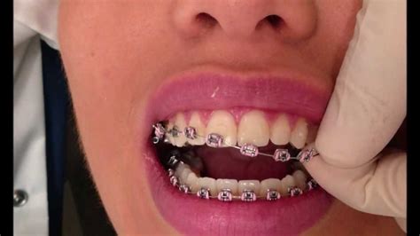 How Braces Are Removed Youtube