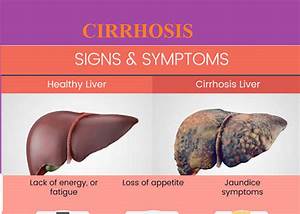 Cirrhosis Signs & Symptoms - Medical eStudy Cirrhosis  