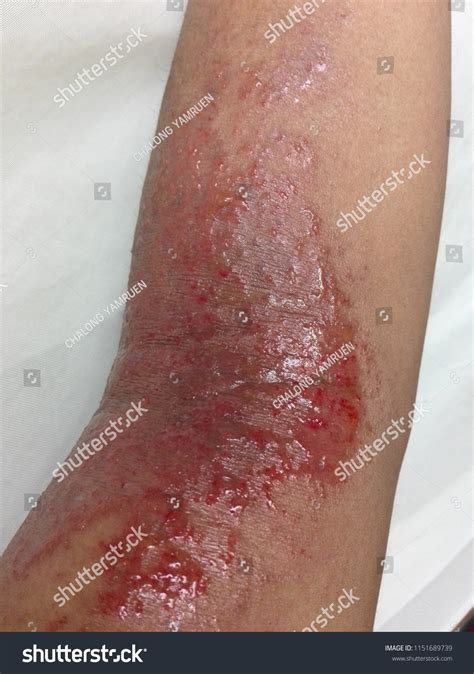 Dermatitis Rash Lymph Stock Photo Edit Now 1151689739