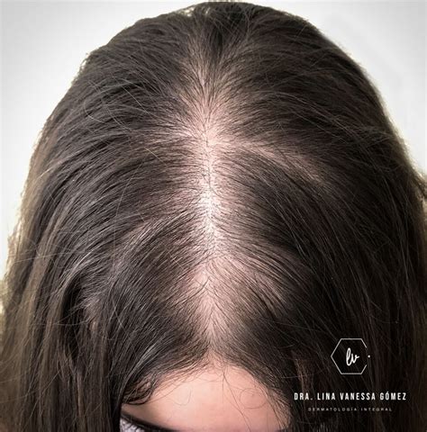 Alopecia Androgenética De Patrón Femenino Archivos Lina Vanessa Gómez