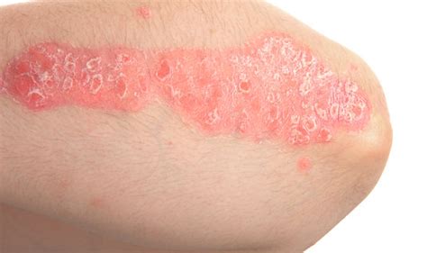 Flaking Sore And Dry Skin Five Tips To Beat This Chronic