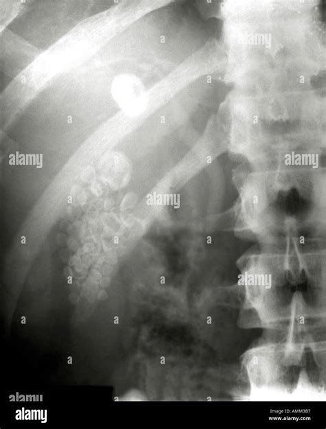 Abdominal X Ray Gallstones In Gallbladder Stock Photo Alamy