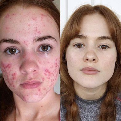 Fotos La sorprendente transformación de joven con severo caso de acné
