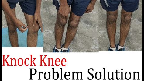 Knock Knee Problem Solution In Telugu Devendar Lifeguru Youtube