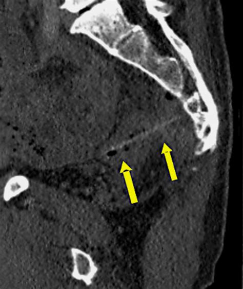 Ct Scan Showing A Rectal Perforation Caused By A Foreign Body The