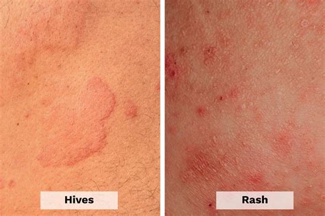 hives vs rash here s how to tell the difference the healthy