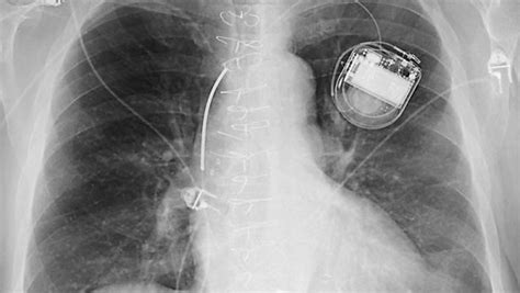 Qu Es Un Cardiodesfibrilador Implantable Ecuarritmias